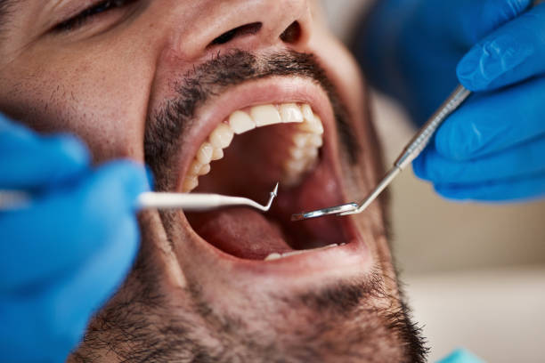 Best Emergency Root Canal Treatment in Aurora, SD