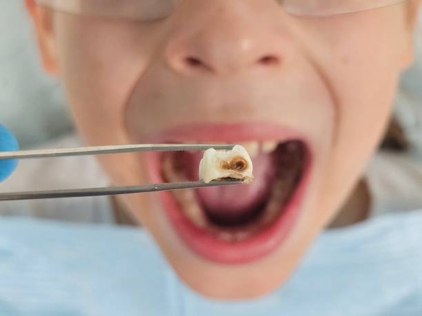 Best Emergency Treatment for Toothache in Aurora, SD